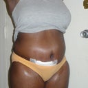 5 wks post-op
