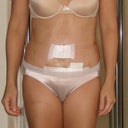 PO day 8:  Front view.  I see a waist peeping through.  I haven't had a waist in so long!!!