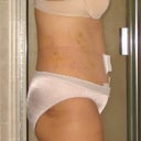 Post day 8:  Side view.  Still swellling in my lower abdomen.  Still have bruising from flank lipo.