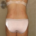 Post day 8:  Back View.  PS said that I still have swelling in dependent areas such as my lower abdomen and back that may take weeks/months to completely go away.  That's okay.
