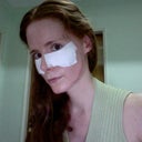 Day 2 of my the phenol peel on my lower eye lids and six months after my full face phenol peel. You can see the phenol scar on my chin which is red but fading.