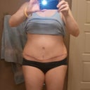 2 months post-op