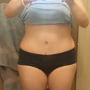 2 months post-op