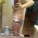 3 days post op- right-side view