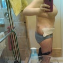 3 days post op- left-side view.