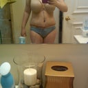 3 days post-op, front view, no gauze