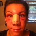 So swollen...2 days after surgery