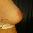 12 days: my lovely right breast