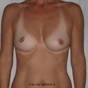 pre surgery