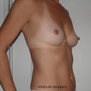 pre surgery- oblique