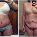 Before Surgery & Two Weeks Post OP