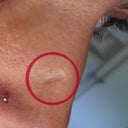 the bb sized mole on my nose removed, leaving a crater