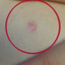 the mole on my chest removed that was bb size, leaving a pea size scar