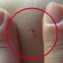 the mole on my knee that was only partially removed