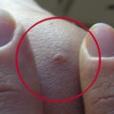 the other mole on my knee that was only partially removed. the one Janee refused to complete the removal of.