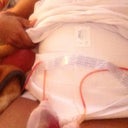 Post op day 2
