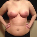 Day 15 post op. redness from possible infection and/or possible allergic reaction to steri strips??