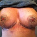 Day 2 post op... no drains...that's my sports bra.  I had a reduction from size DD to a full C with lipo.