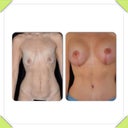 This is the before picture and Postop 2 month picture. Big difference.