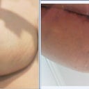 Day 10 Lefty looks okay from front..but that brown stuff just will not go away and got 2 drops of blood from he nipple....the worse story gets worse when one looks from below....