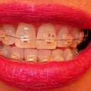 The coloring is off in this photo, but see I am not crazy the teeth are still bunched up after 1-1/2 yrs of Invisalign so this is day one of Ceramic Braces.