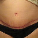 Scar close up 6 Weeks PO