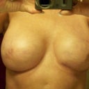 2nd implants Dr. Pinsky. Notice the difference in cleavage and symmetry compared to the 1st photos. The rt breast you can see the scar but it does have a pocket below that instead of the above pic. When scar has lightened it the breast will be more uniform.