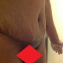 PO Day 15.  Fewer Stretch Marks.  Still tender and swollen
