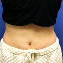 July 2011 - after 2 treatments