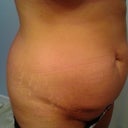 1 day pre op... so gross! Ive lived with this since my 1st child was born 1988, both my kids were C sections. KEEP IN MIND.. I have 18% Body fat & when surgery was done, there was NO lipo cause i had no fat, so this is all skin & stretch marks & muscle damage from pregnancy.