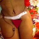 Day 4 Scar is VERY low.  I'm leaning slightly so hips might look uneven.  I'm gonna talk to Yily about a butt-out garment.