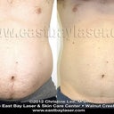 One month after my treatment