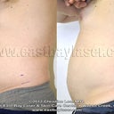 One month after my treatment