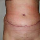 After healing from 1st TT. The swelling area along the top of the scar isnt swelling. It was actually a ring of fat he left. I look like I had a spare tire wrapped around me. The BB area if you look closer was pushed in and the area around it looked swollen. But this is 1 yr Post OP.