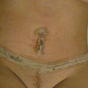 This is days after 2nd TT. You can see that the scar is drastically lower and my waist and stomach have been shaped beautful by Dr. Nijher. The ltape under my BB is where the area of my old BB was pulled to. I was tightened so much that by pressure it opened a little. But still healed nicely. I am going in 2 weeks for my few revisions and I will post new me pics in a bikini. YAYAYA!!