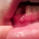 Infected lower implant