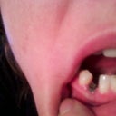Implant showing through the gum- NOT supposed to look like this!