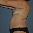 front - 1 week post