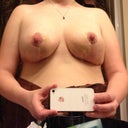 2 weeks after-scar lines