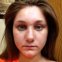 My Right side is really bruised and swollen...