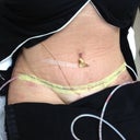 1 day post op at PS office.  He said everything looked good.