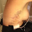 3rd day post op brusing on right side.