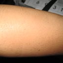 After 7th treatment