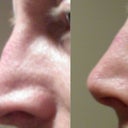 Nasal bridge redness and swelling resolving nicely.