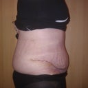 Day 10 Post Op - very swollen in my lower stomach.
