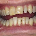 Incisal edges October 2012 Before Treatment