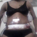 day after tt surgery