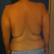 Before, Day of Lipo -4/13/12