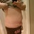6 months post op