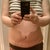 6 months post op
